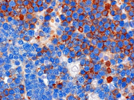 La colorazione marroncina rivela l’espressione sulla superficie delle cellule tumorali del BCR. Il colore azzurro rivela un marcatore cellulare comune sia alle cellule tumorali BCR+ e BCR negative.
