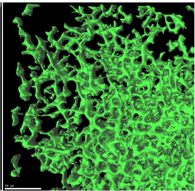 Ricostruzione tridimensionale della struttura metastatica