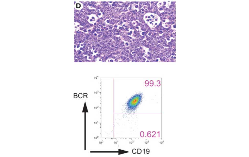 Burkitt lymphoma